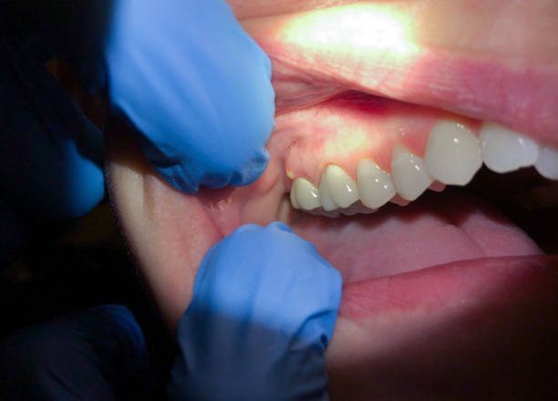 Best Urgent Care for Lost Fillings or Crowns in Falcon Heights, MN